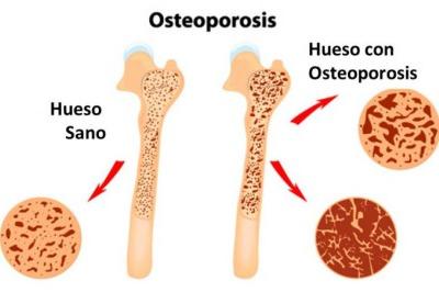Alimentación anti-osteoporosis. Tratamiento natural