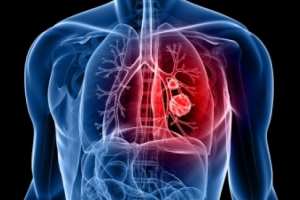 Alimentos preventivos del cáncer pulmonar