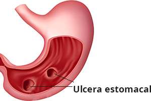 Imagen ilustrativa del artículo Ulcera péptica, alimentos que favorecen su tratamiento