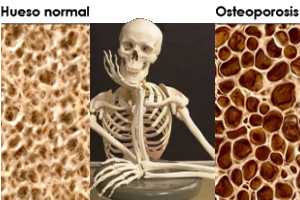 Cómo prevenir o tratar la Osteoporosis