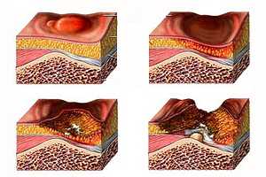Imagen ilustrativa del artículo Tres jugos naturales para tratar las úlceras