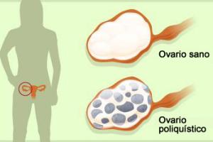 Ovarios poliquisticos sintomas