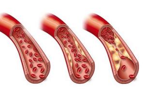 Alimentos reductores de placa arterial creada por el colesterol