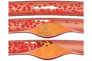 Imagen ilustrativa del artículo Infusiones como tratamiento natural para la Arteriosclerosis