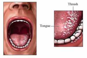 Tratamientos caseros para la Candidiasis oral