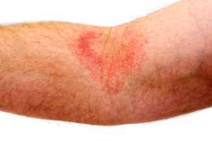 Imagen ilustrativa del artículo Remedios naturales para el  Tratamiento de Eczemas